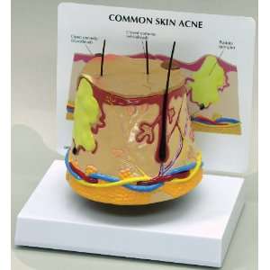 Skin Acne Anatomical Model:  Industrial & Scientific