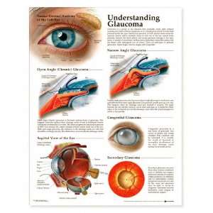  Understanding Glaucoma Anatomical Chart Paper Unmounted 